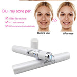 Blue Light Therapy Acne Laser Pen Soft Scar Wrinkle Removal Treatment Device Skin Care Beauty Equipment - Heritage cosmetics and beauty care